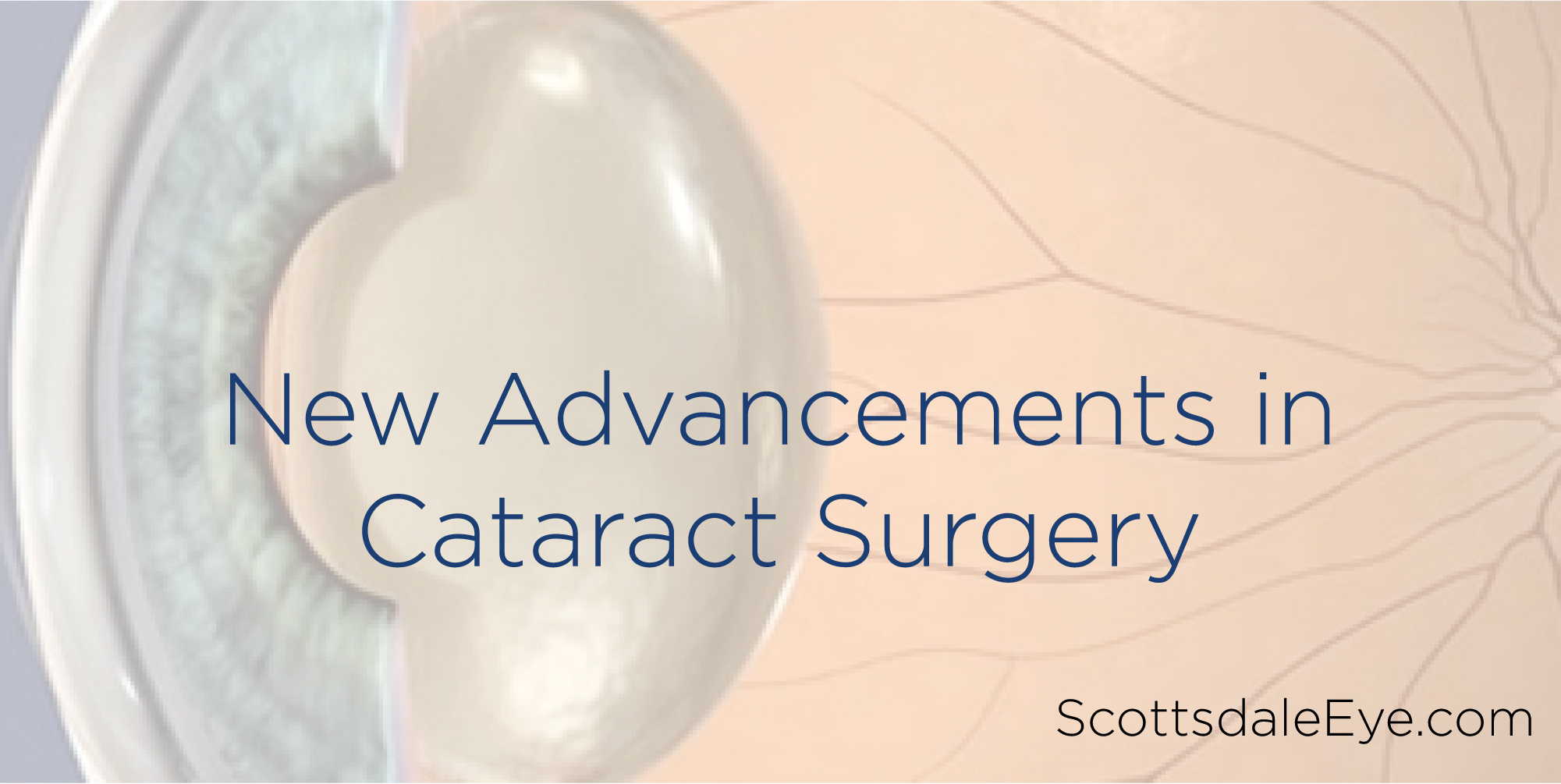 New Advancements in Cataract Surgery