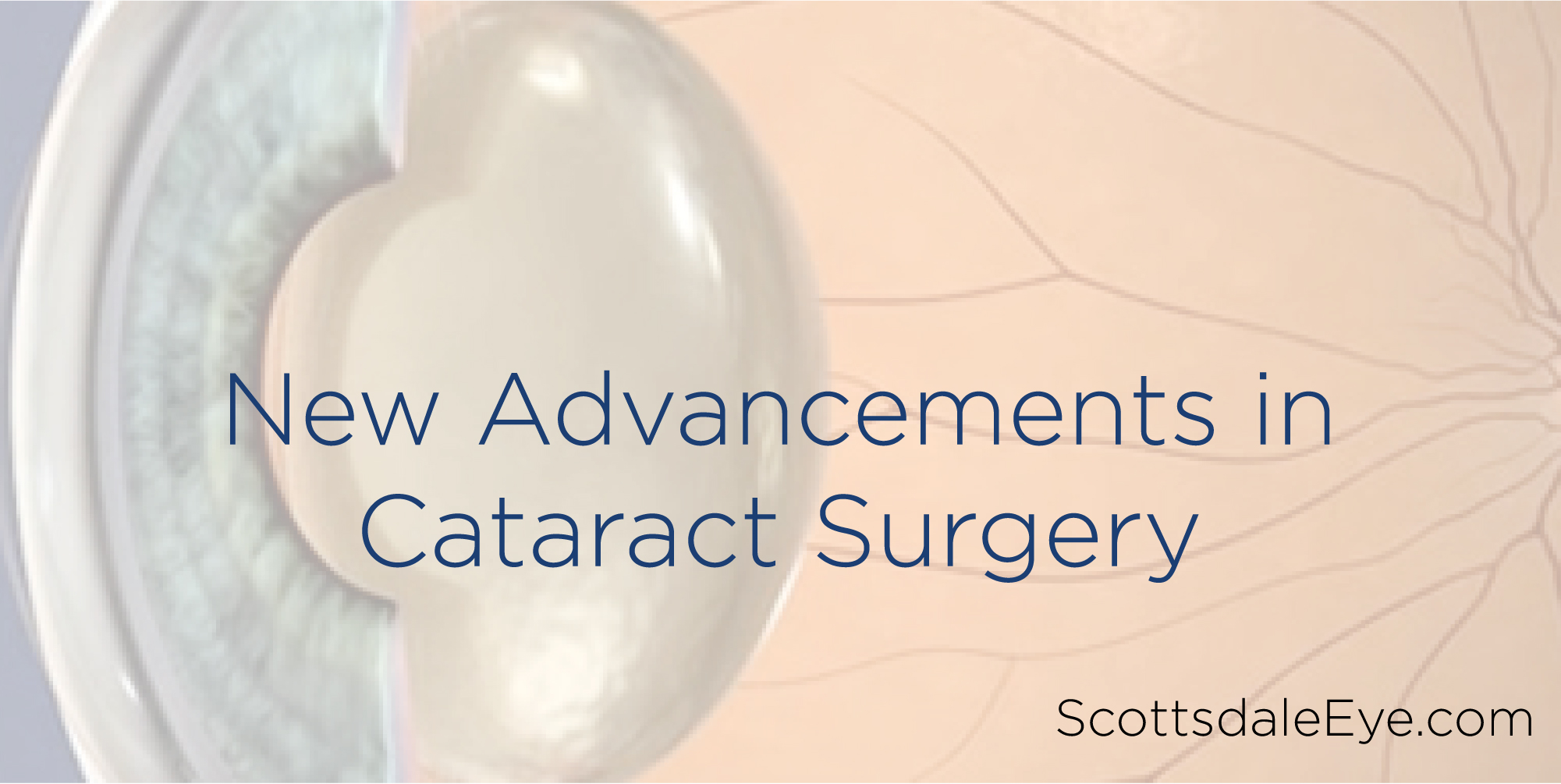 New Advancements in Cataract Surgery post thumbnail image