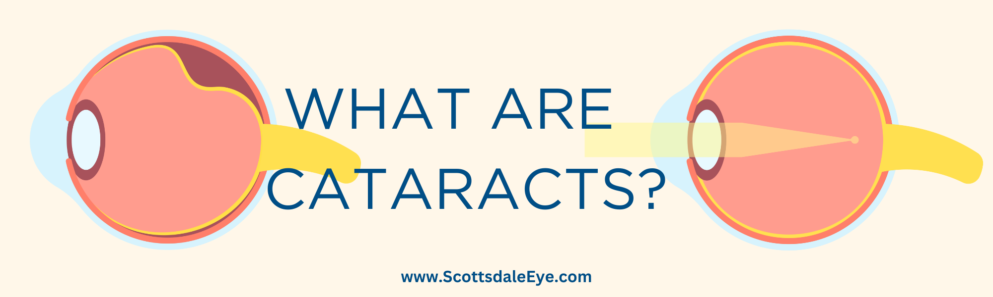 Understanding the Effects of Cataracts on Your Eyes
